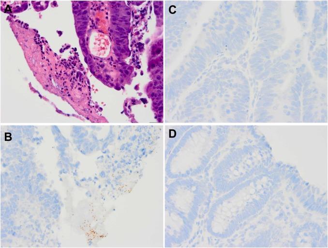 diagnostico helicobacter pylori gastroenterólogo guatemala